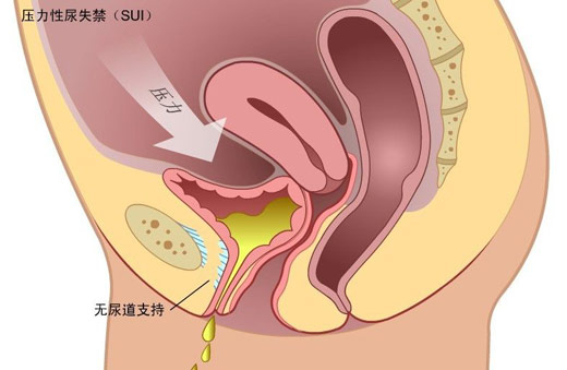 盆底康復(fù)之慢肌、快肌訓(xùn)練篇